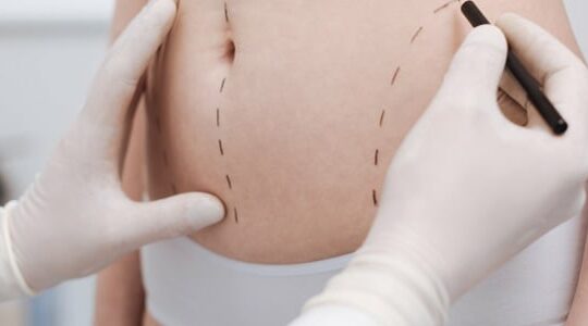 liposuccion-du-ventre-est-ce-vraiment-efficace